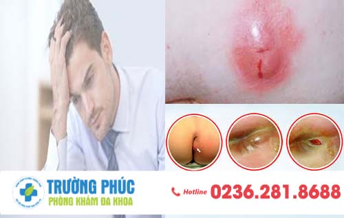 Áp Xe Hậu Môn Và Cách Điều Trị Hiệu Qủa