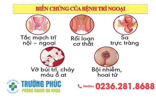 Cấp độ 4 của bệnh trĩ ngoại nguy hiểm như thế nào? Phương pháp điều trị hiệu quả