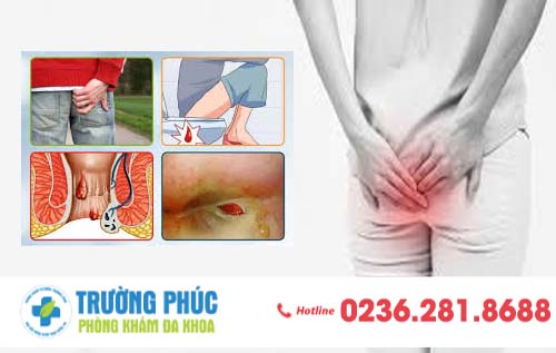Triệu Chứng Nhận Biết Bệnh Trĩ