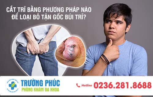 Cắt trĩ bằng phương pháp nào để loạt bỏ tận gốc búi trĩ?