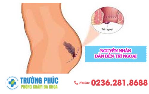 Tìm Hiểu Những Nguyên Nhân Dẫn Đến Bệnh Trĩ Ngoại