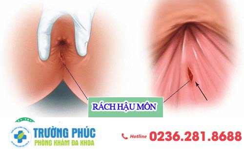 Vì sao bị rách hậu môn?