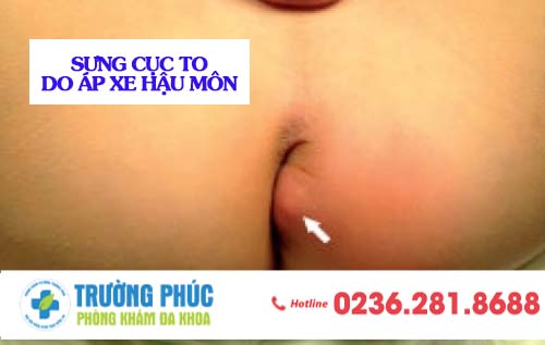 Sưng Cục To Ở Hậu Môn Phải Làm Sao?