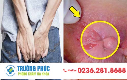 Những Triệu Chứng Điển Hình Của Bệnh Trĩ Nội