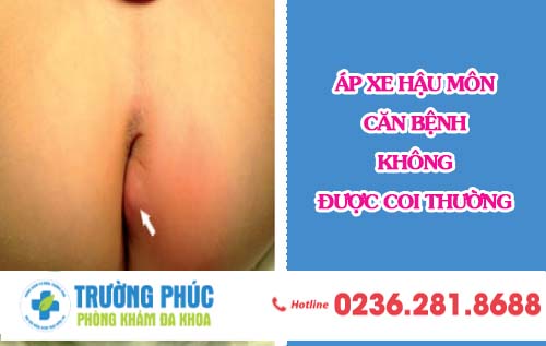 Áp Xe Hậu Môn - Căn Bệnh Không Được Coi Thường