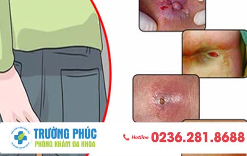 Những bệnh lí hậu môn mà bạn có thể gặp phải