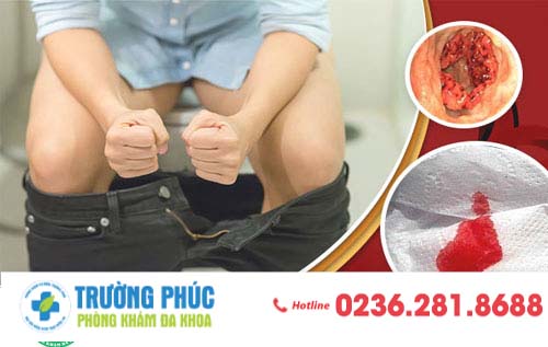 Hình của bệnh trĩ – nhận biết chính xác để điều trị kịp thời