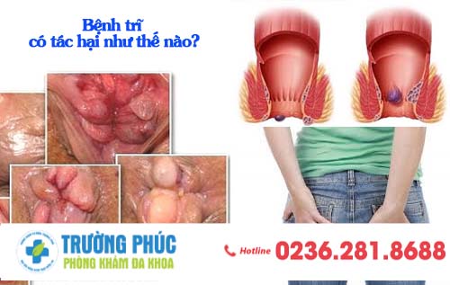 Bệnh trĩ có tác hại như thế nào?