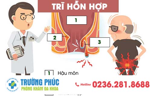 Trĩ Hỗn Hợp Và Những Tác Hại Nguy Hiểm Khó Lường
