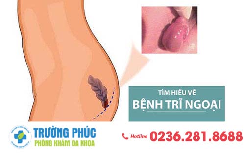 Những biểu hiện trĩ ngoại bạn cần biết