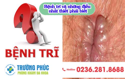 Bệnh trĩ và những điều nhất thiết phải biết