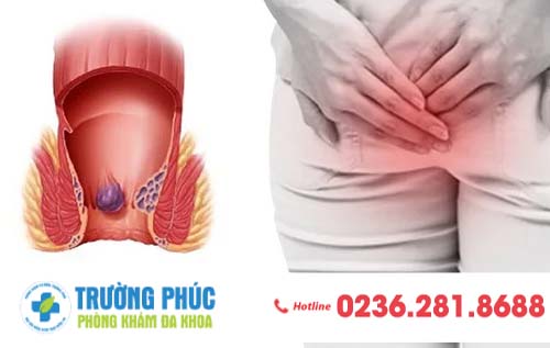Nhận biết dấu hiệu trĩ nội qua từng cấp độ