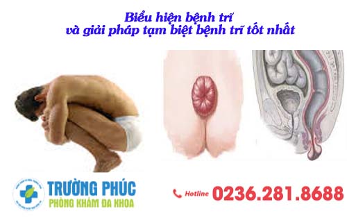 Biểu hiện bệnh trĩ và giải pháp tạm biệt bệnh trĩ tốt nhất