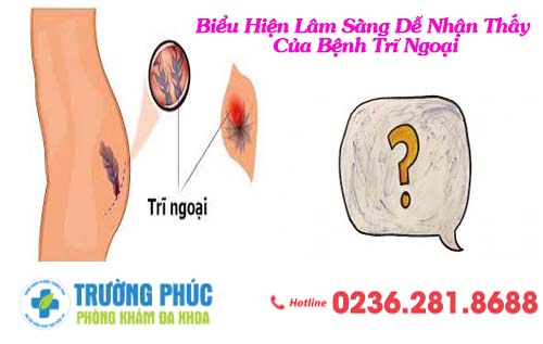 Biểu Hiện Lâm Sàng Dễ Nhận Thấy Của Bệnh Trĩ Ngoại
