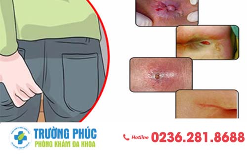 Hậu Môn Tiết Chất Nhầy Là Bệnh Gì?