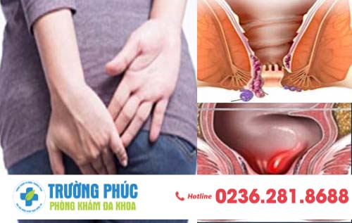 Các cấp độ trĩ nội mà bạn nên biết