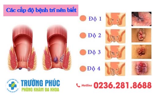 Các cấp độ bệnh trĩ nên biết
