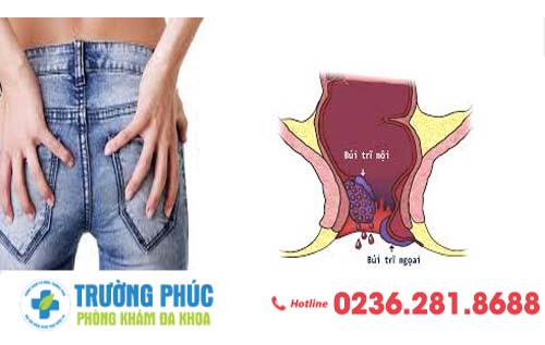 Cẩm nang về bệnh trĩ mà bạn cần biết