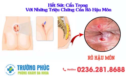 Hết Sức Cẩn Trọng Với Những Triệu Chứng Của Rò Hậu Môn