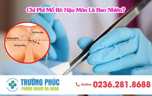 Chi Phí Mổ Rò Hậu Môn Là Bao Nhiêu?