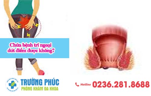 Chữa bệnh trĩ ngoại dứt điểm được không?