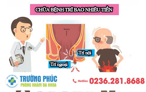 Chữa bệnh trĩ bao nhiêu tiền ?