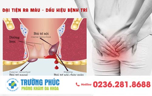 Đại tiện ra máu là dấu hiệu bệnh gì? Có gây nguy hiểm không?