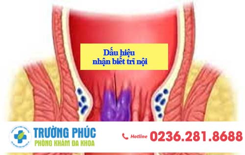 Các dấu hiệu nhận biết bệnh trĩ nội và nơi điều trị hiệu quả