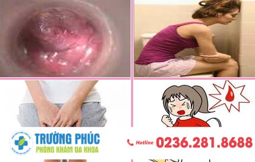Dấu hiệu nhận biết bệnh trĩ ở nữ giới