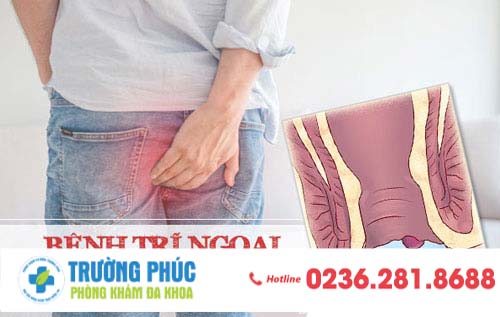 Dấu hiệu nhận biết bệnh trĩ ngoại và cách điều trị nhanh khỏi