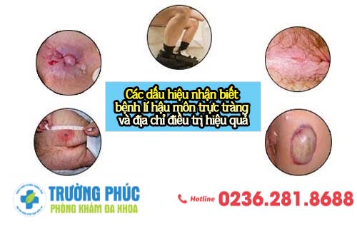 Các dấu hiệu nhận biết bệnh lí hậu môn trực tràng và địa chỉ điều trị hiệu quả