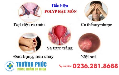 Dấu hiệu polyp bệnh hậu môn