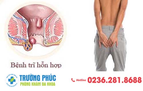 Dấu hiệu nhận biết bệnh trĩ hỗn hợp