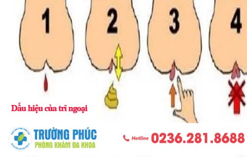 Các dấu hiệu nhận biết bệnh trĩ ngoại và nơi điều trị hiệu quả
