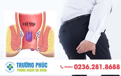 Dấu hiệu nhận biết bệnh trĩ nội