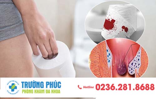 Đi cầu ra máu nhưng không đau là bệnh gì?