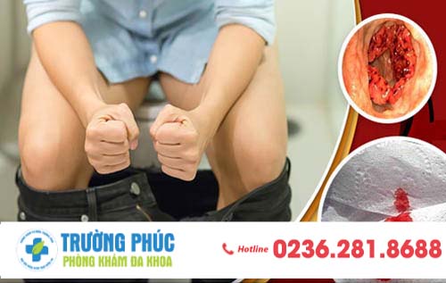 Biểu hiện trĩ ngoại là gì?