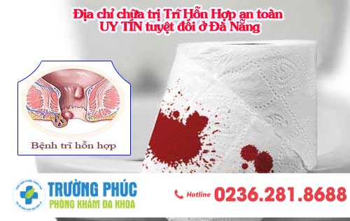 Địa chỉ hỗ trợ điều trị trĩ hỗn hợp