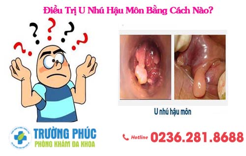 Điều Trị U Nhú Hậu Môn Bằng Cách Nào?