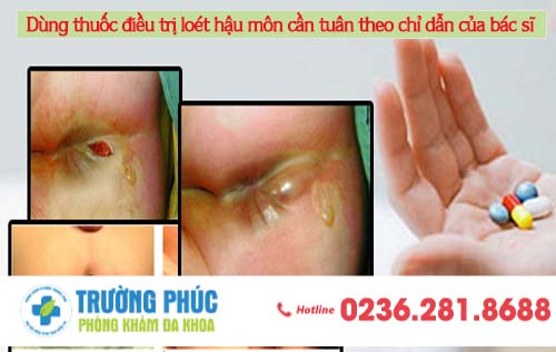 Điều trị loét hậu môn cần tuân theo chỉ dẫn của các bác sĩ