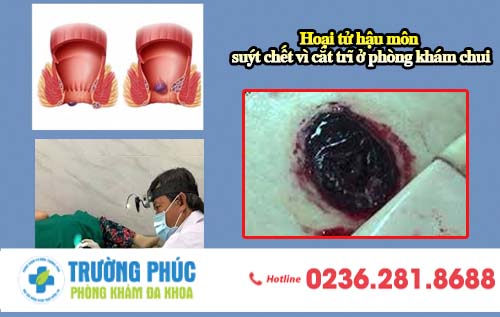 Hoại tử hậu môn - suýt chết vì cắt trĩ ở phòng khám chui