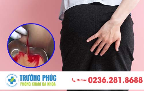 Hậu Môn Chảy Mủ Là Triệu Chứng Của Bệnh Gì?