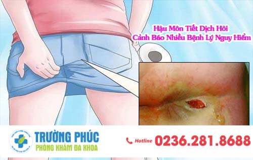 Hậu Môn Tiết Dịch Hôi Cảnh Báo Nhiều Bệnh Lý Nguy Hiểm