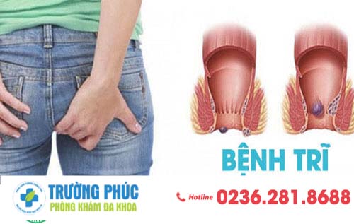 Hình ảnh các cấp độ của trĩ và dấu hiệu điển hình