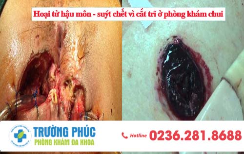 Nguy hiểm khi điều trị bệnh trĩ tại phòng khám chui