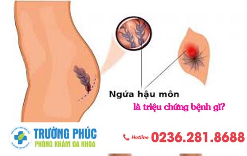 Ngứa hậu môn là triệu chứng bệnh gì?