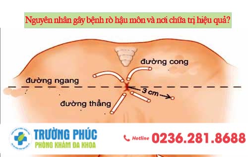 Nguyên nhân gây bệnh rò hậu môn và nơi chữa trị hiệu quả?