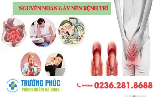 Nguyên nhân gây nên bệnh trĩ mà bạn không ngờ