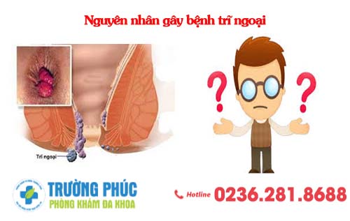 Nguyên nhân gây bệnh trĩ ngoại