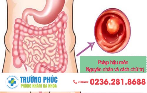 Nguyên nhân gây ra bệnh polyp hậu môn và cách chữa trị hiệu quả